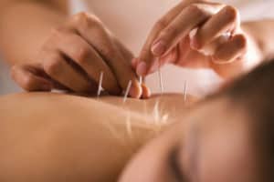 Does Medicare Cover Acupuncture